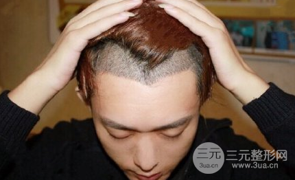 植发价格表