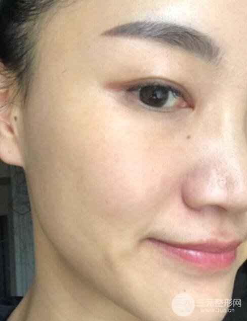 激光祛斑经历分享