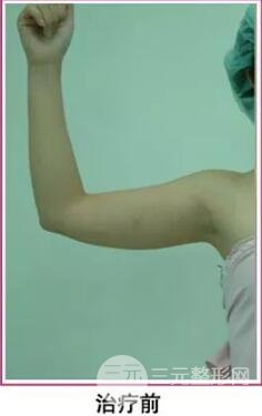 胳膊吸脂价格影响因素