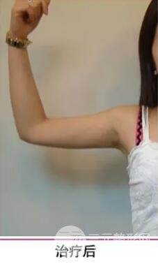 胳膊吸脂价格影响因素