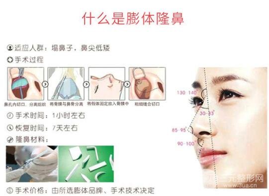 膨体隆鼻会变形吗?