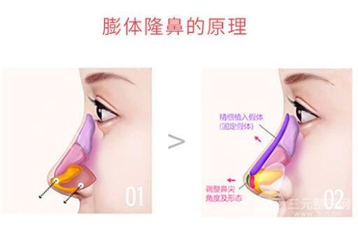 膨体隆鼻会变形吗?