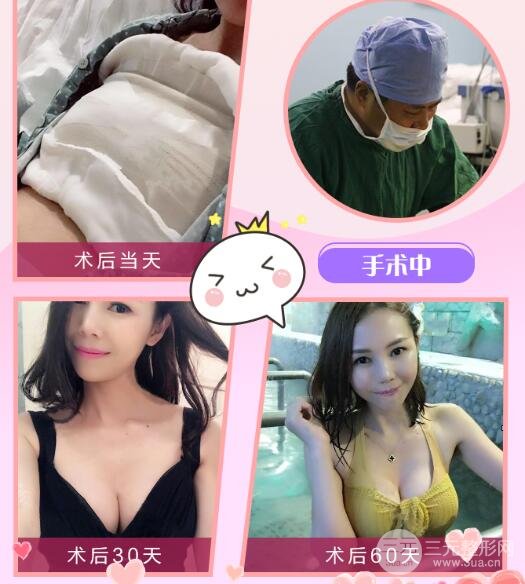 美国曼托妙桃娜绮丽、娜高等隆胸假体哪个好?