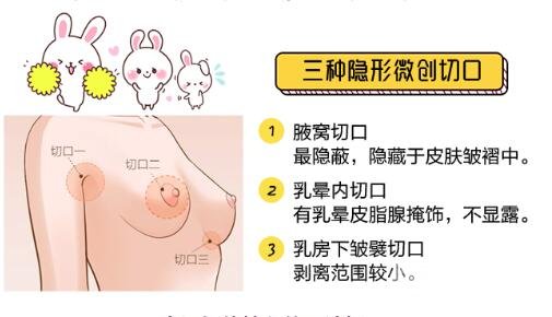 隆胸假体选择注意事项