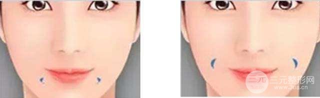 [术前攻略]酒窝整形价格是多少，甜美女生必得~