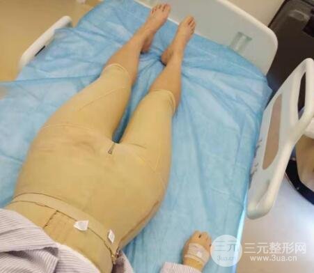 臀部吸脂