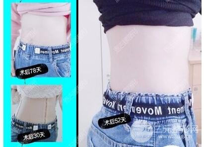 腹部吸脂手术果图