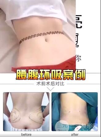 腹部吸脂手术果图