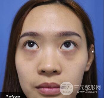 内路去眼袋后的果