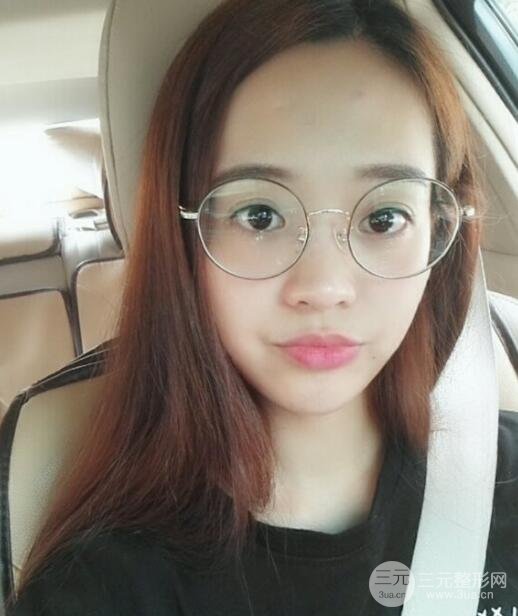 内路去眼袋后的果