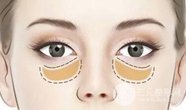 内路去眼袋后注意事项