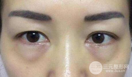 内路去眼袋后注意事项