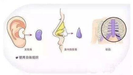 自体软骨隆鼻