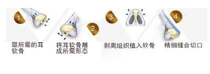 硅胶隆鼻果
