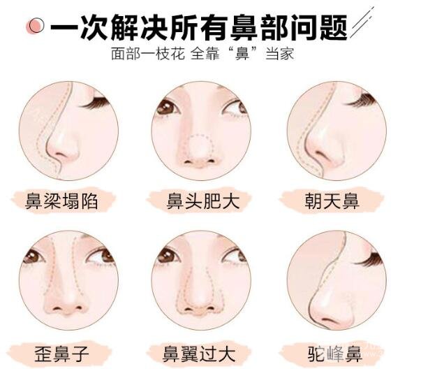 硅胶隆鼻优点