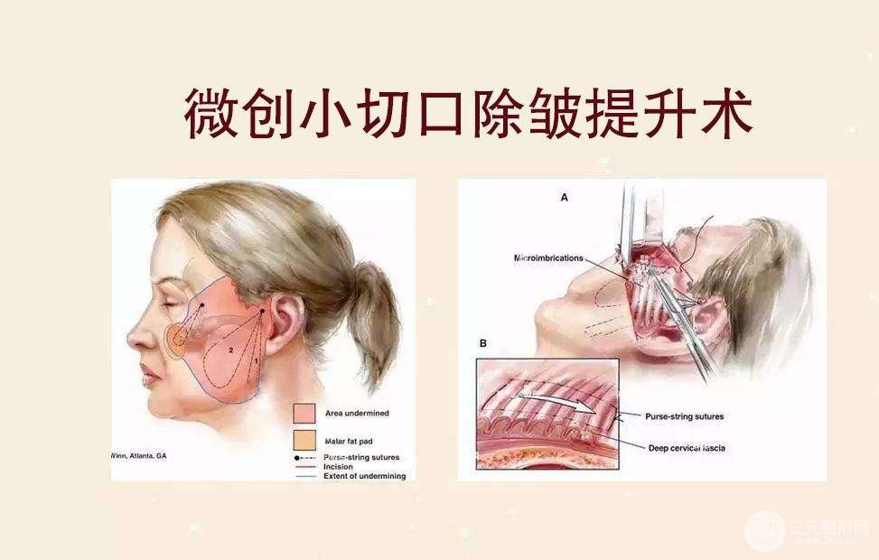 [专业解答]微创面部除皱术痛苦吗？术后如何护理？