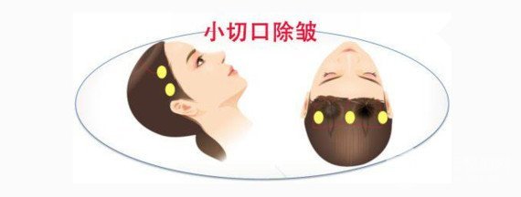 [专业解答]微创面部除皱术痛苦吗？术后如何护理？