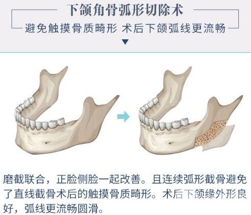 下颌角颧骨磨骨技术