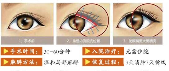 开外眼角项目介绍