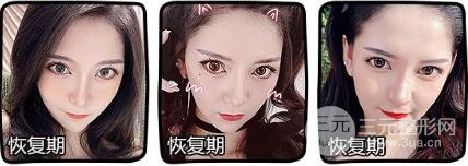 开外眼角前后对比照介绍