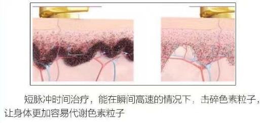手术祛斑原理解析