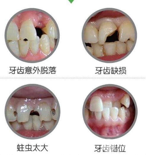 烤瓷牙使用寿命
