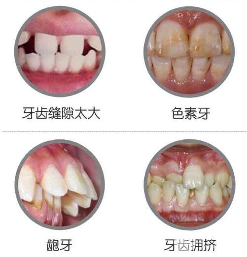 烤瓷牙使用寿命