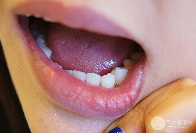 做完烤瓷牙的注意事项