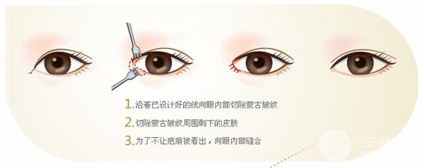 [术前功课]开大眼角手术包括哪些手术？手术过程解析~