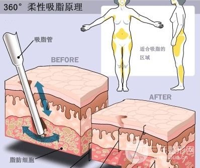 腿部吸脂塑形手术