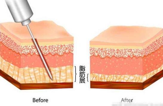大腿吸脂手术介绍