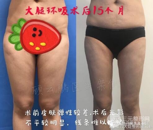 如何避免风险和副作用