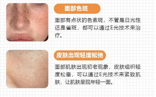 e光嫩肤适应症