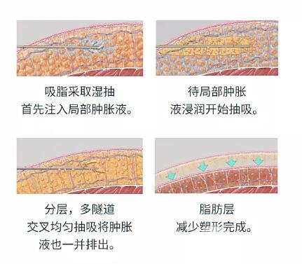 抽脂瘦腿技术介绍