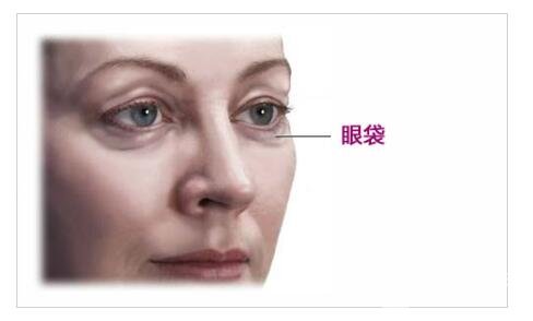 眼袋形成的原因