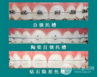 医院可以粘托槽吗