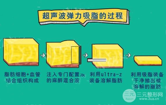 超声吸脂减肥手术原理及实记果