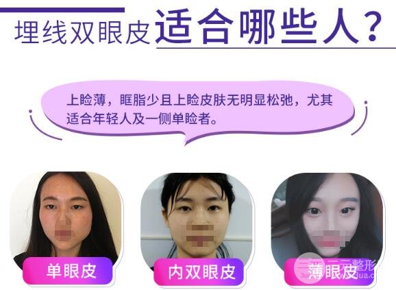 埋线重睑术为啥会“掉”？