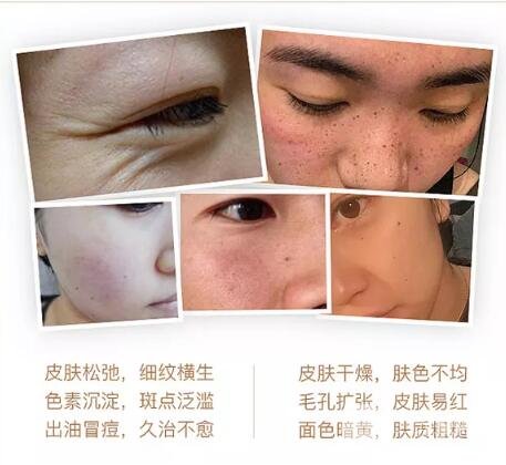 光子嫩肤原理介绍