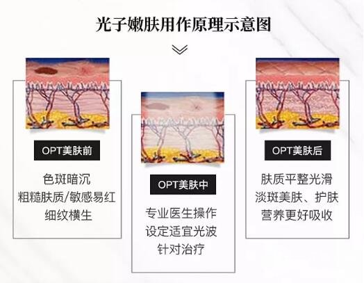 光子嫩肤的可靠性