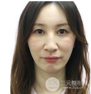 面部注射除皱案例
