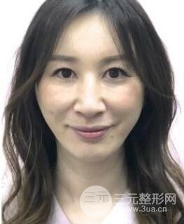 面部注射除皱案例