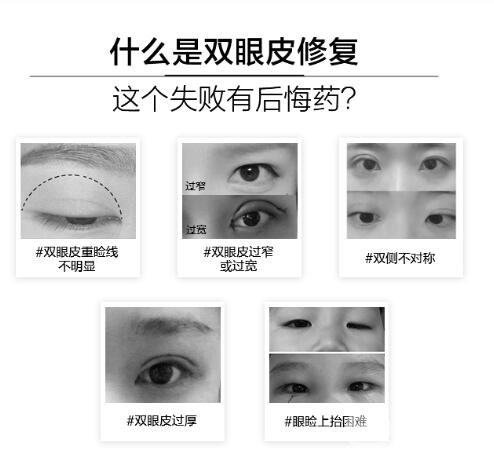 失败双眼皮修复时机