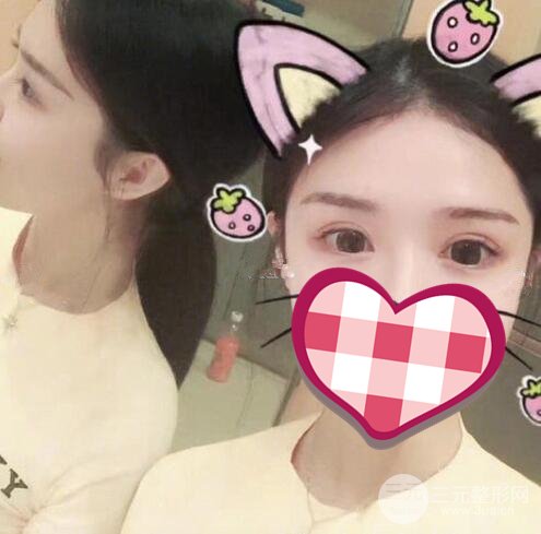 失败双眼皮修复案例