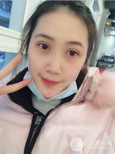 韩式翘睫双眼皮的优点
