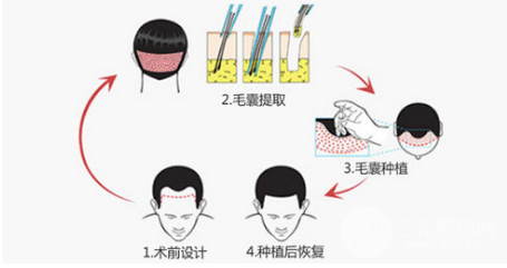 种植头发的价格