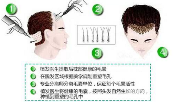 种植头发的价格