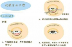 内切祛眼袋解决你眶隔脂肪多的问题！get灵气大眼睛~