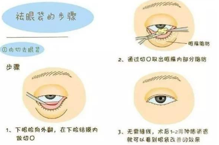 内切祛眼袋解决你眶隔脂肪多的问题
