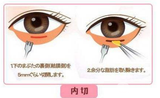 内切祛眼袋解决你眶隔脂肪多的问题